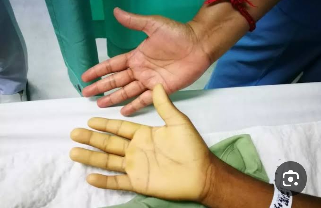 Sure—here’s a clear overview of anemia in pregnancy