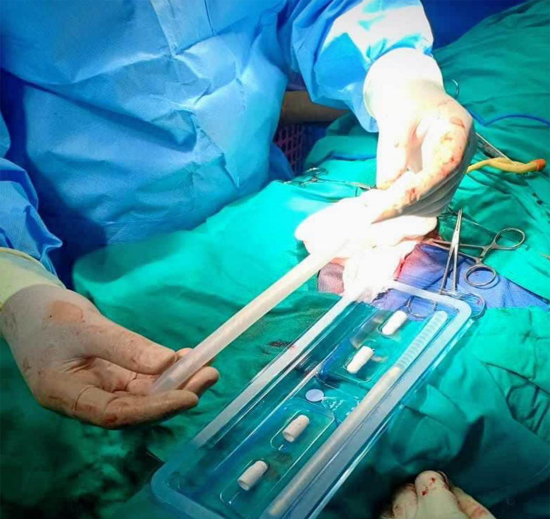 نجاح عملية دعامة لمريض عمره ٦٨ عامابمستشفي فيديليتي بجوبا